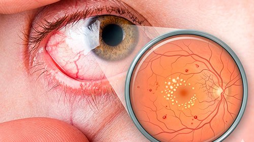 Retina